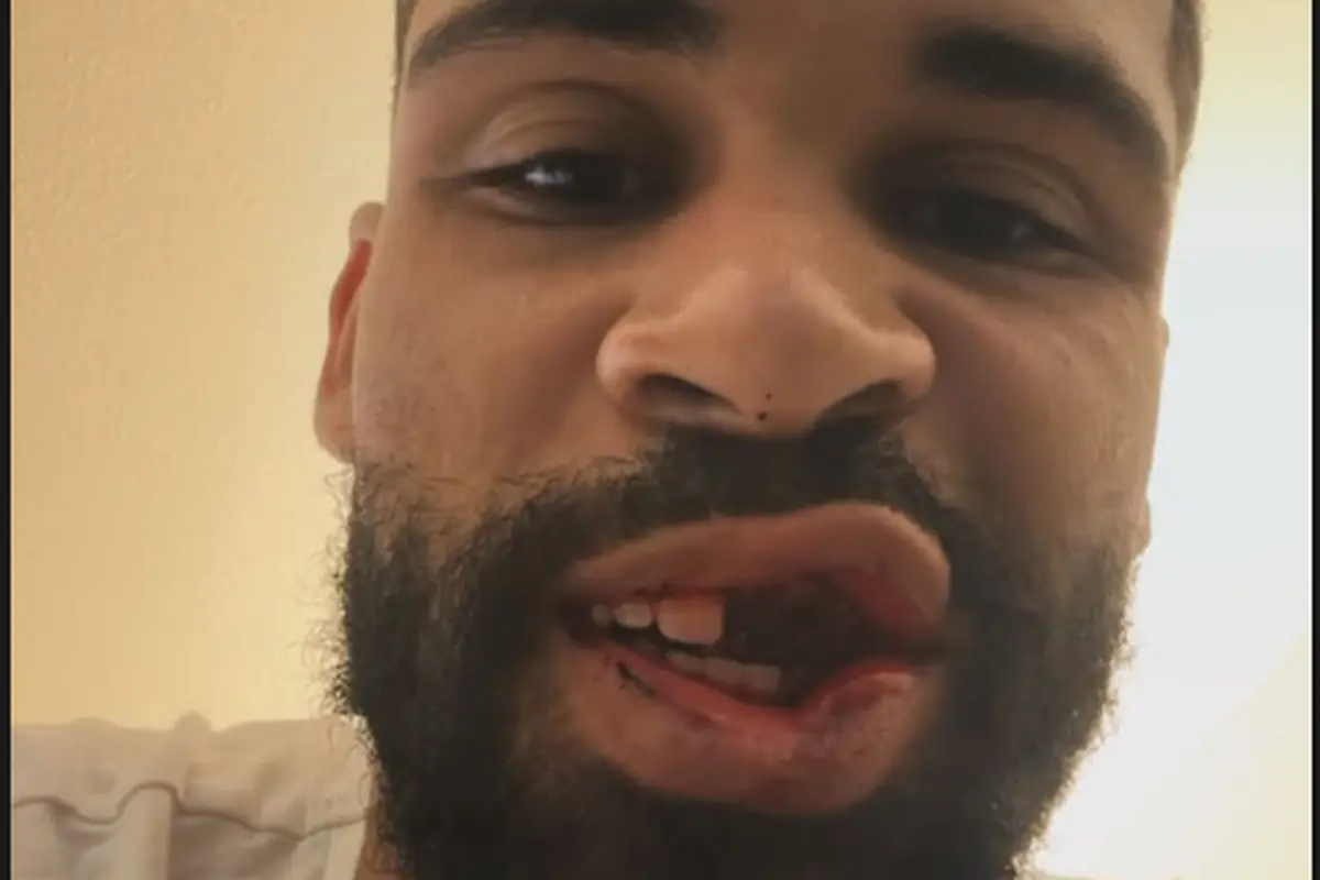 Infortunio mascella Loftus Cheek