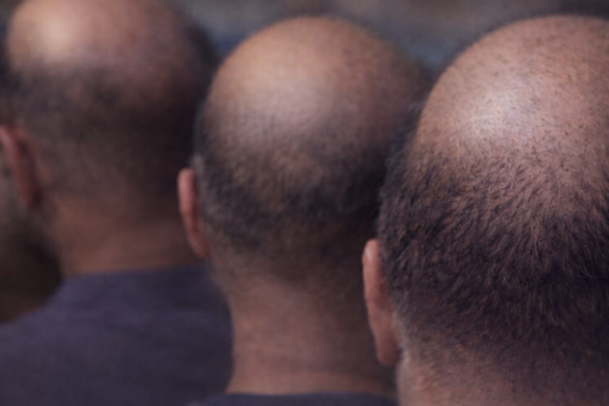 Nonostante non esista una cura definitiva per la calvizie, alcune ricerche preliminari indicano che l'uso topico di succo di cipolla